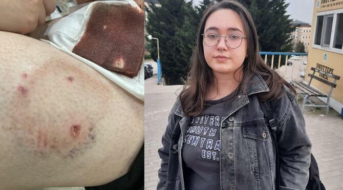 Üniversite öğrencisi kampüste köpek saldırısına uğradı  