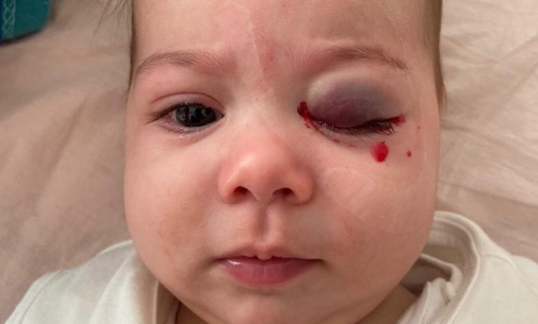 Adana'da 7 aylık bebeğe yanlış ameliyat edildiği iddası