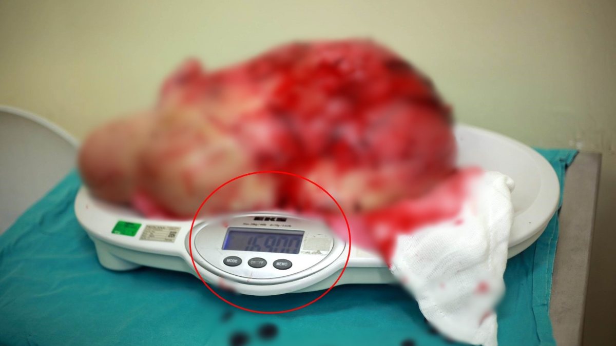 Samsun'da hastanın karnından 16,9 kiloluk dev kitle çıktı